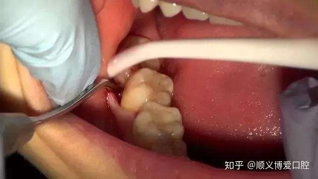 为什么牙医让拔掉智齿？看完你就知道了！
