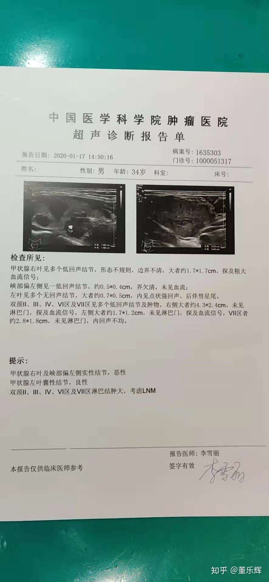 低分化甲状腺癌 分化差的甲状腺癌 肺转 病例分享 更新中 知乎