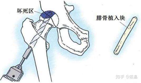拿什么拯救你我坏死的股骨头