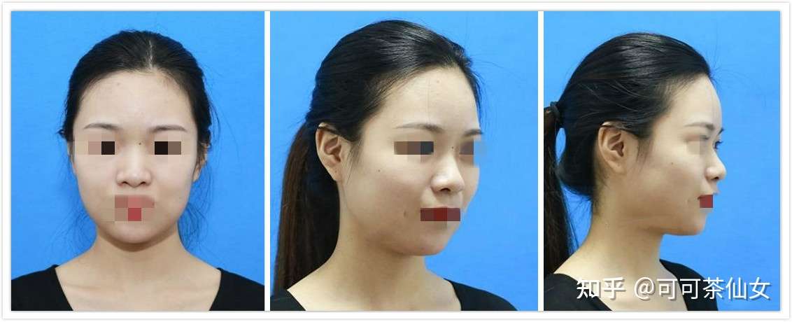 成都隆鼻有哪些做自然风性价比高的医生 知乎
