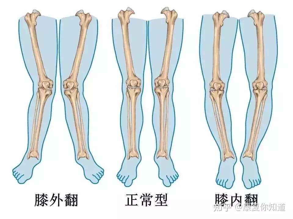 O 型腿 X 型腿详解及矫正方案 知乎