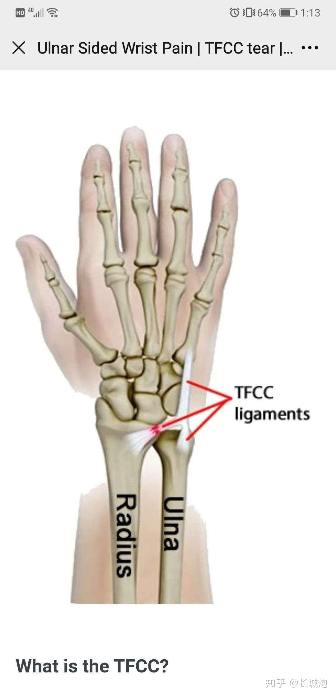 Tfcc手腕三角软骨复合体科普 知乎