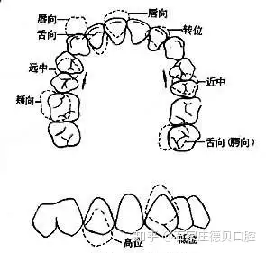 3,咬物壞習慣及用嘴呼吸的習慣,均會造成上牙弓狹窄,顎蓋高拱,上頜牙