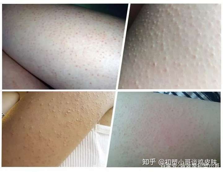 激光治鸡皮肤有效吗(鸡皮肤激光可以根治吗)