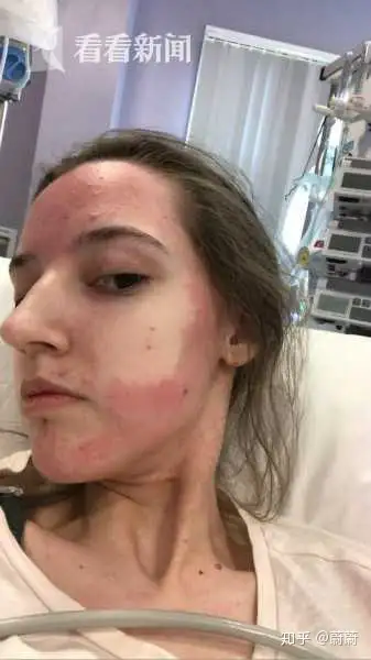 英国女子对所有食物和酒精过敏两年内瘦31公斤