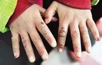 手冷是种什么程度的酷刑