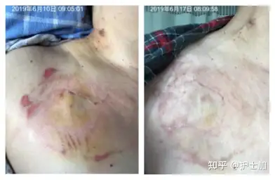 输液港使用中,局部皮肤瘙痒破损咋办?不妨试试这些办法