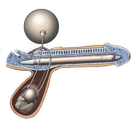 北京医院王鑫医生 的想法: 哪些男性可以做"阴茎假体植入"?