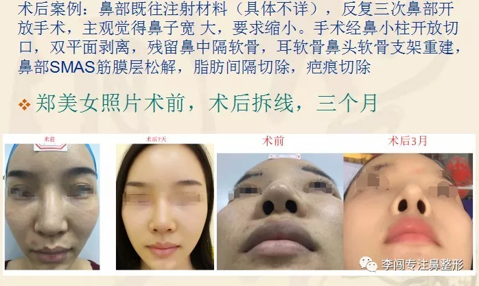 鼻形成術 = Aesthetic Rhinoplasty : 美容外科手術手技 | www