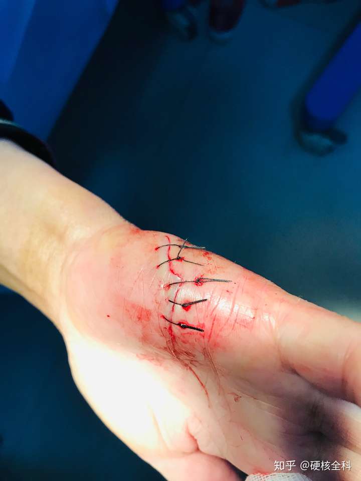 为什么做手术的时候,家属不能进去?