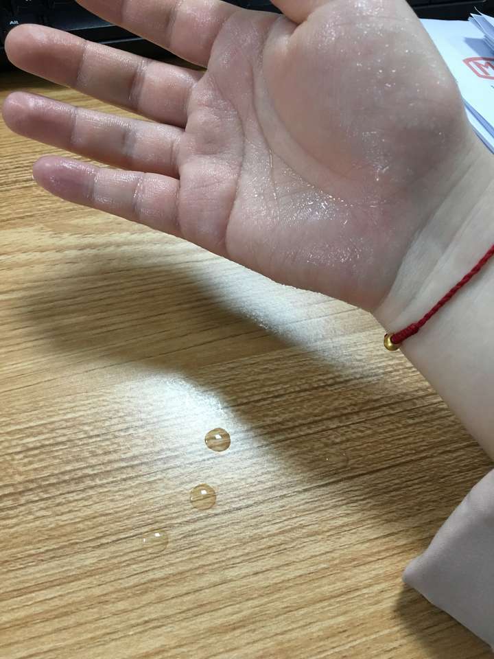 手汗症到底能不能手术?