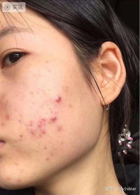 你都用过什么效果特别好的祛痘,祛痘印的产品? - 知乎