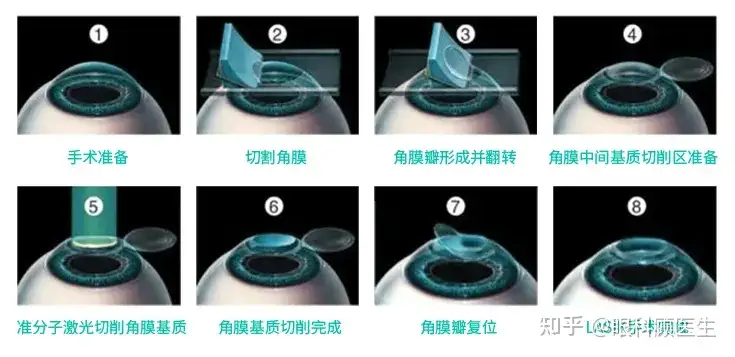 近视手术后得了白内障能不能做白内障手术？ - 知乎