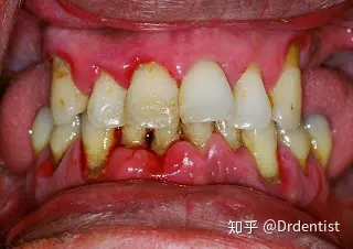 您健康的牙龈应该是粉红色的,金字塔的形状,刷牙时不容易出血,几没有