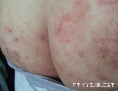 如何预防?北京哪家医院治疗股癣