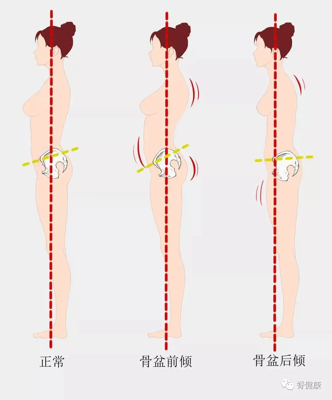 骨盆不稳男阳痿 女漏尿 六个动作稳定骨盆 知乎