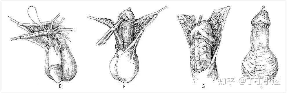 尿道口长错了怎么办 尿道下裂的诊疗指南 知乎