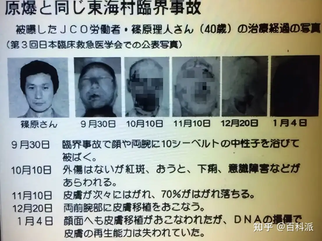 史上“最”悲惨的死法：被医生强行续命83天，亲眼看着自己腐烂- 知乎
