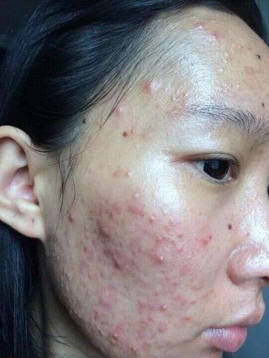 怎样去除脸部浪肿很久的痘印