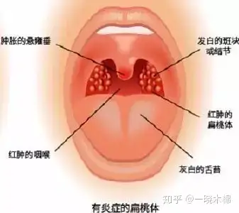 扁桃体肿大原因图片