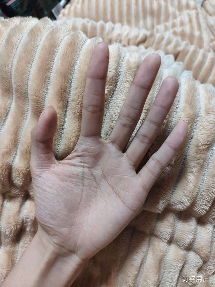 请问鱼鳞病患者的手都是老人手吗?