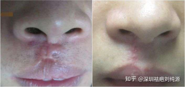 嘴唇有疤,挺多年了,有什么好办法淡化或者弄掉吗?