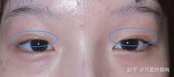 请问我这样的眼型是内眦赘皮还是上睑下垂呢