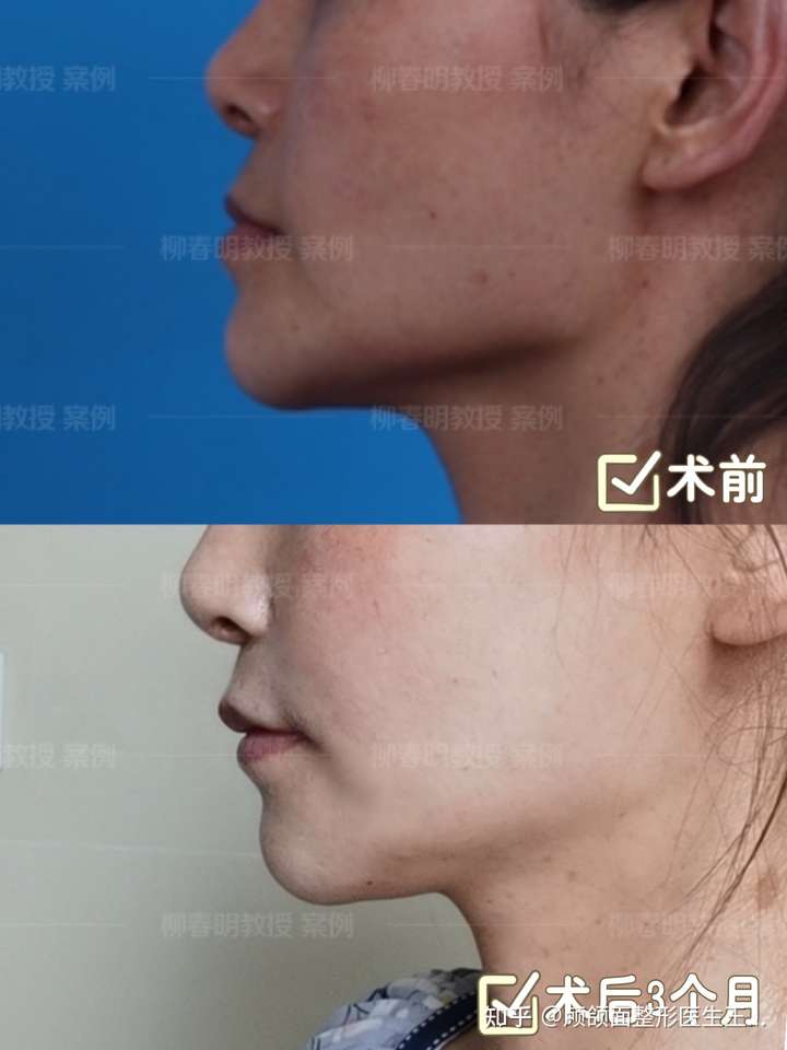 月亮脸怎样矫正?下巴很翘侧脸很丑,怎么办?