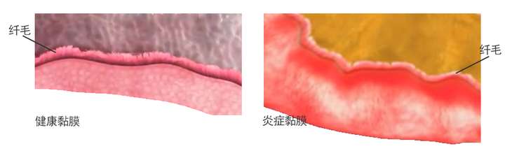 健康黏膜与炎症黏膜对比