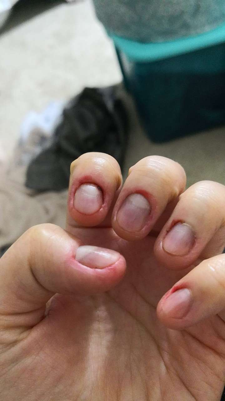 如何控制不自觉的没完没了的撕手皮?如何恢复手指皮肤的状态?