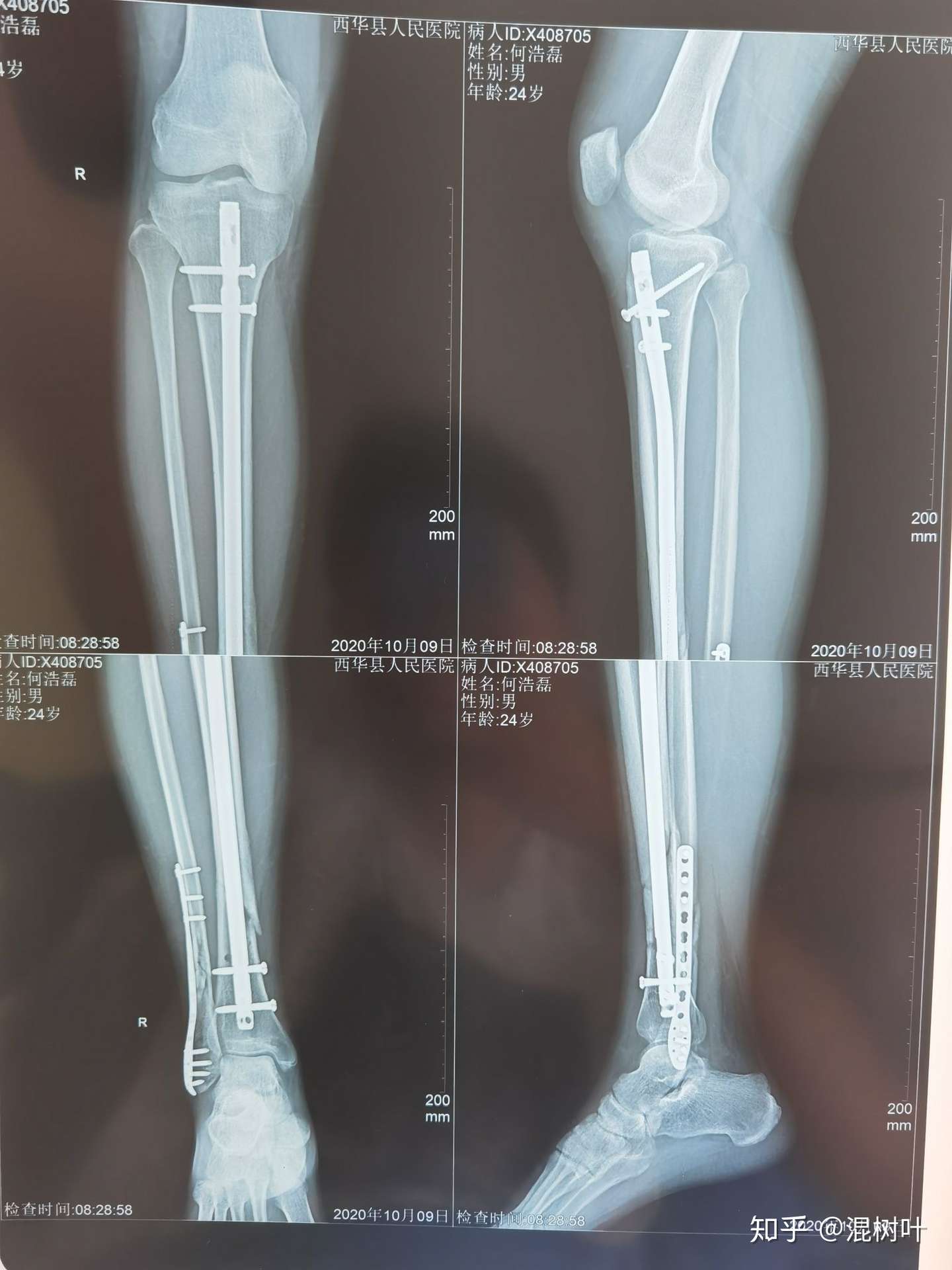 从骨折到骨折手术后记录 知乎