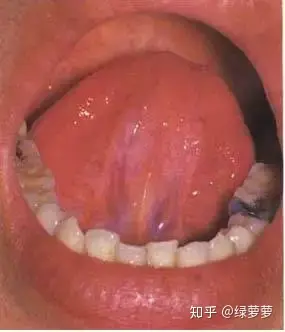瘀血体质的舌象