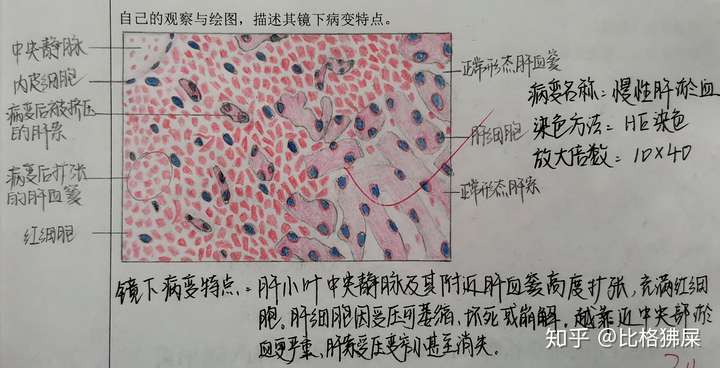肝细胞脂肪变手绘图图片