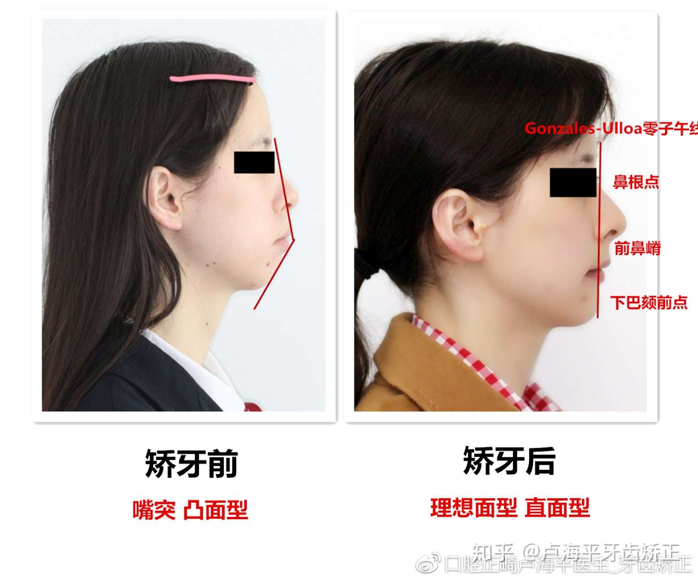 嘴突vs侧颜 牙齿矫正让你的侧颜美上天 知乎