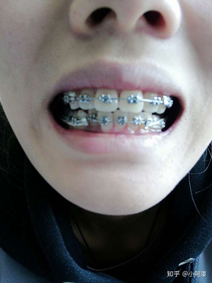 全同步带状弓矫治技术的优缺点有哪些