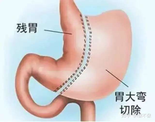 缩胃手术 减肥手术 医疗险被拒赔怎么破 知乎