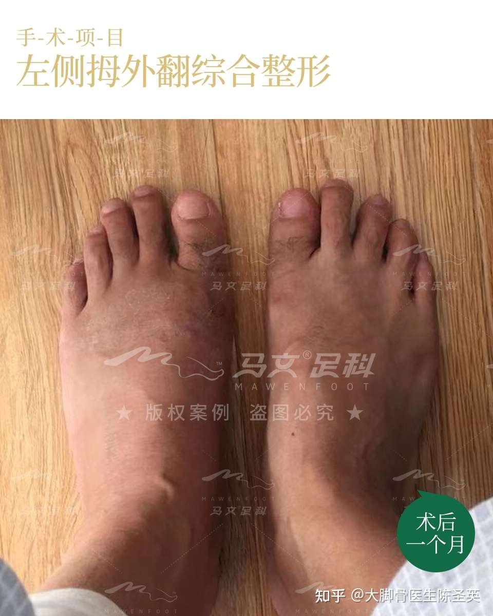 当男性遇上大脚骨怎么办 知乎