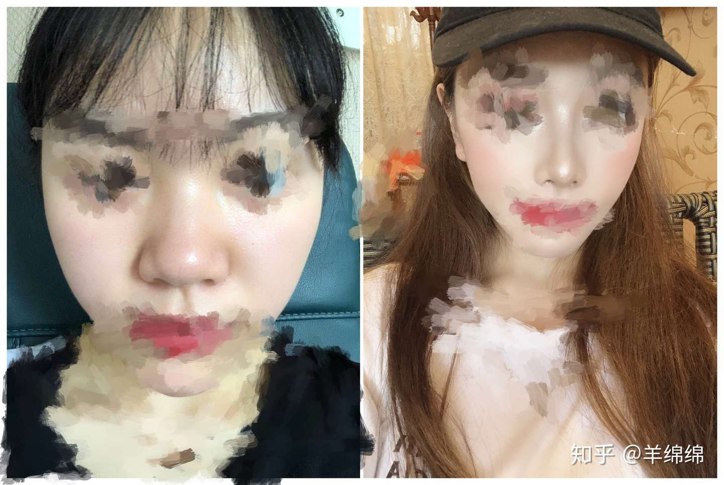 矯正 小鼻