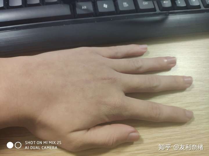 冬季如何防手和耳朵冻伤已经冻伤要如何处理
