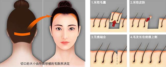 哪些情况可以种植发际线 知乎