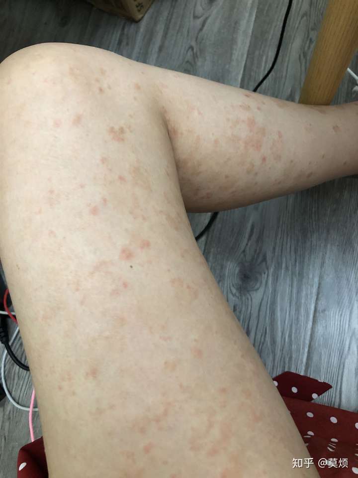 大战玫瑰糠疹三个月日晒77酒精77中药