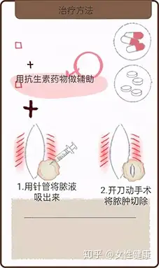 前庭大腺囊肿怎么治疗图片