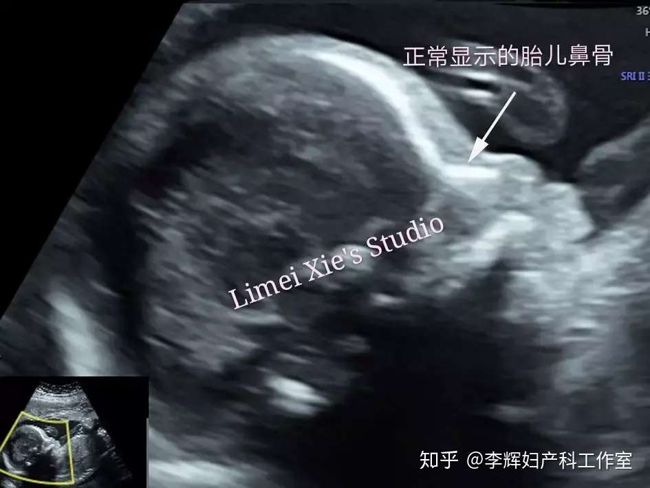 胎儿鼻骨缺失和 或发育不良的医生专业指导 知乎