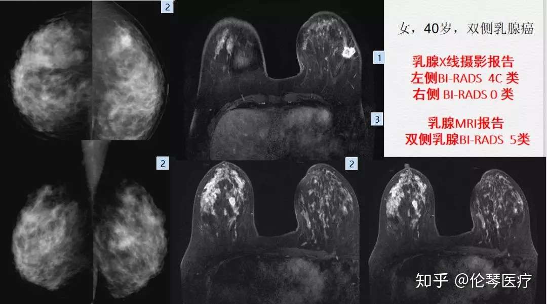 伦琴医疗核心专家汪登斌教授 如何读懂乳腺影像学检查报告 知乎