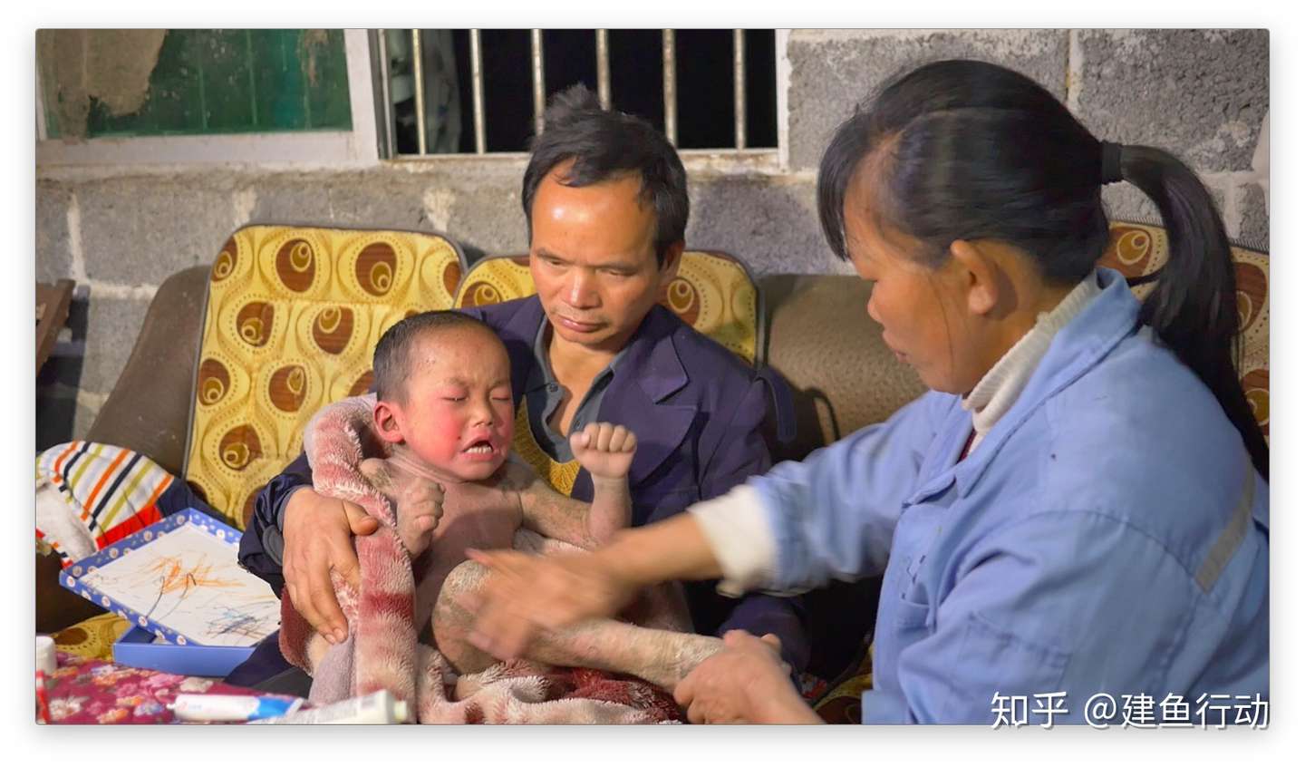 北京张健鱼鳞病关爱中心公益活动广西天峨站 Day 2 知乎