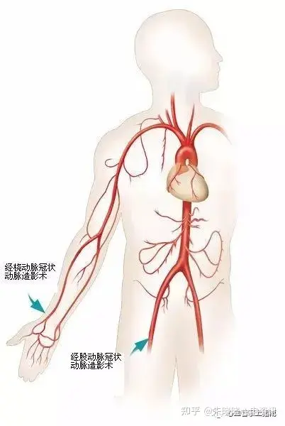 冠脉造影血管解剖图图片