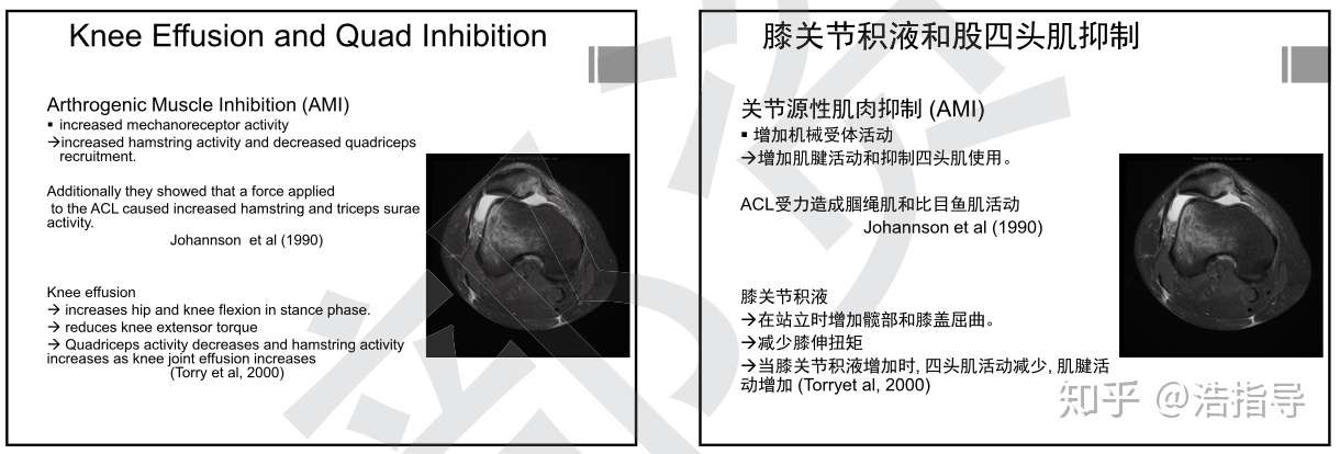 膝关节积液和股四头肌抑制 要及时处理好积液问题哟 知乎 膝关节积液和股四头肌抑制 要及时处理好积液问题哟 知乎
