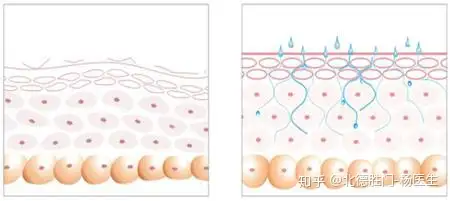 鱼鳞病为什么会皮肤干燥 祛除鱼鳞病的3个小妙招 知乎