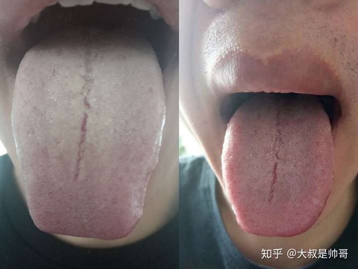 肾阴虚舌苔图片