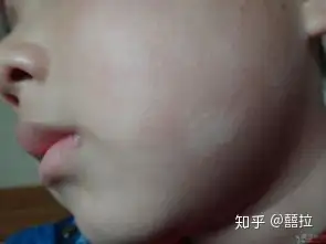 宝宝脸上的白色糠疹怎么回事